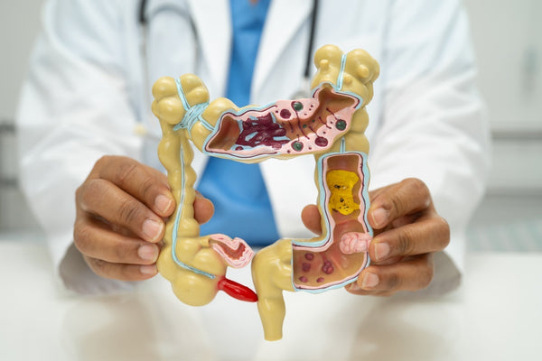 Arzt hält ein anatomisches Modell des menschlichen Dickdarms mit sichtbaren Tumoren und Polypen – Symbolbild für Darmkrebs und seine Entstehung im Verdauungstrakt.